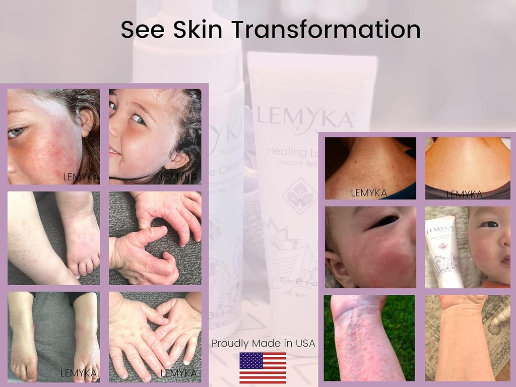 rosacea-cream--face-redness-relief-facia-5.jpg