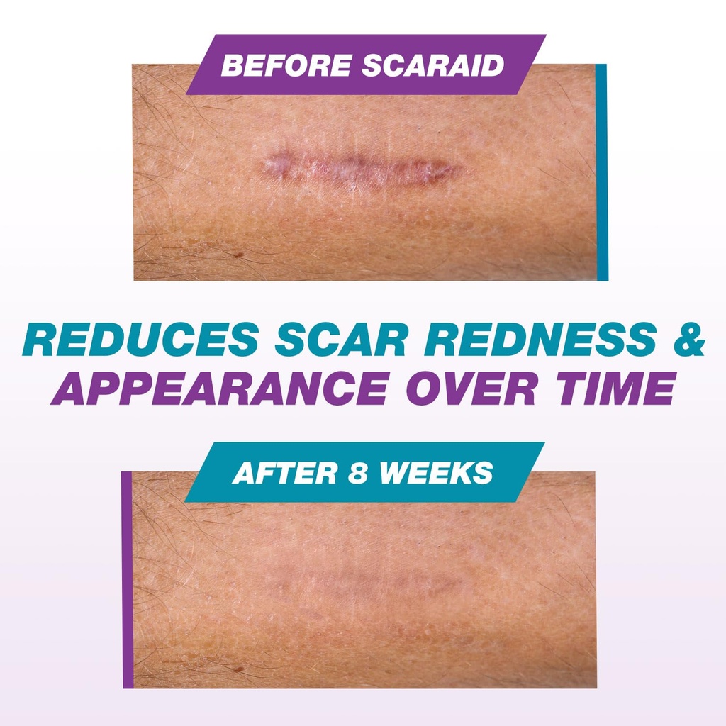 silicone-scar-gel-for-scars-after-surger-5.jpg
